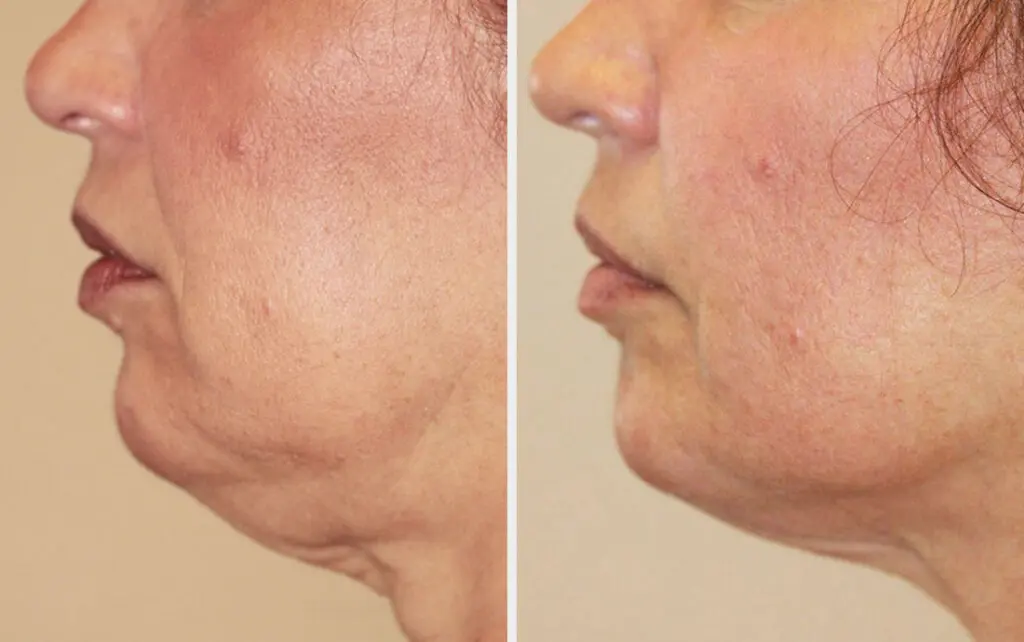 Skin Tightening